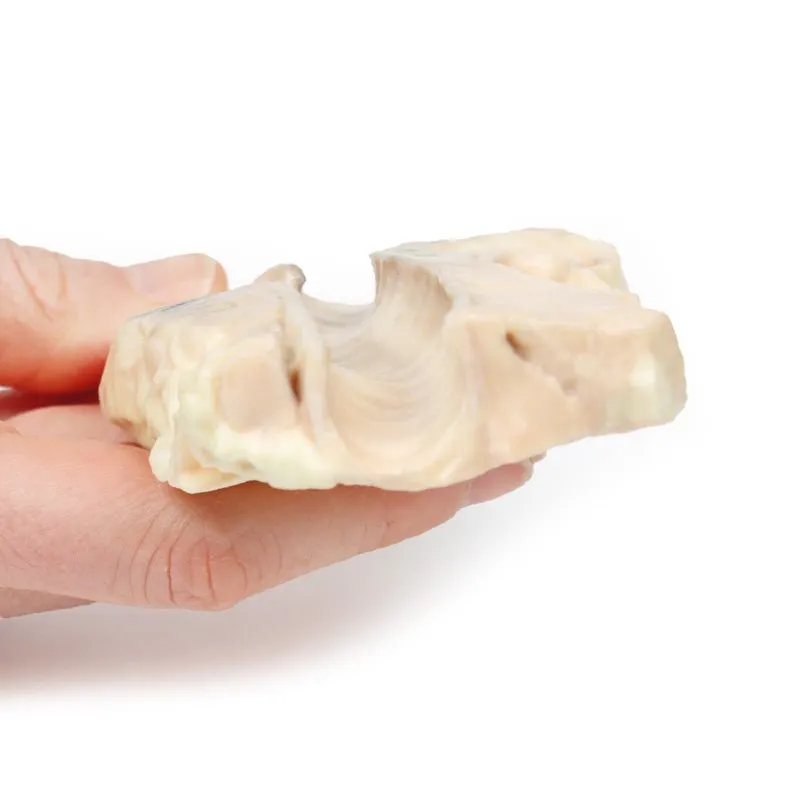3D Printed Trachea - Hodgkin Lymphoma